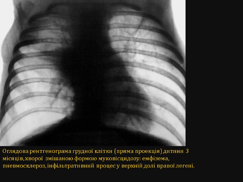 Оглядова рентгенограма грудної клітки (пряма проекція) дитини 3 місяців, хворої  змішаною формою муковісцидозу: